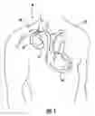 Fig. 02 - Method and apparatus for reliably placing and adjusting a left ventricular pacemaker lead