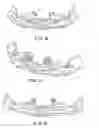 Fig. 03 - Adjustable sealing nasal cannula