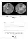 Fig. 02 - Reduction of blurring in view angle tilting MRI