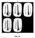 Fig. 09 - Reduction of blurring in view angle tilting MRI