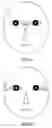 Fig. 10 - Method of beautification and facelifting using a stretch tape