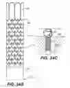 Fig. 35 - TMR shunt