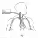Fig. 04 - Compositions, kits, methods, and apparatus for transvascular delivery of a composition to an extravascular tissue of a mammal