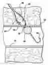 Fig. 01 - Arterial closure device