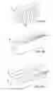 Fig. 12 - Adhesive-based anastomosis method and system