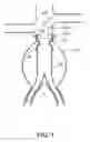 Fig. 02 - Prosthesis fixation device and method