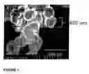 Fig. 02 - Biocompatible cement containing reactive calcium phosphate nanoparticles and methods for making and using cement