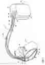 Fig. 02 - Arrhythmia termination detection based on beat pattern