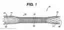 Fig. 02 - Prosthesis comprising dual tapered stent