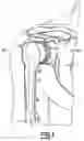 Fig. 02 - Hydroxyapatite backed glenoid prosthesis