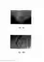 Fig. 32 - Anti-angiogenic compositions and methods of use