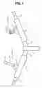 Fig. 02 - Broken collar bone fixing band