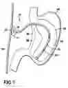 Fig. 02 - Gastro-occlusive device