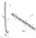 Fig. 02 - Systems and methods for securing fractures using plates and cable clamps