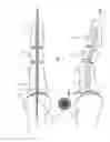 Fig. 02 - Device for temporarily splinting toes