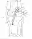 Fig. 01 - Method and apparatus for fixing a graft in a bone tunnel