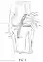 Fig. 03 - Method and apparatus for fixing a graft in a bone tunnel