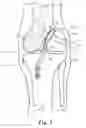Fig. 04 - Method and apparatus for fixing a graft in a bone tunnel