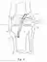Fig. 05 - Method and apparatus for fixing a graft in a bone tunnel