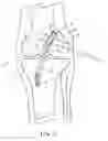 Fig. 08 - Method and apparatus for fixing a graft in a bone tunnel