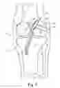 Fig. 10 - Method and apparatus for fixing a graft in a bone tunnel