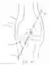 Fig. 14 - Method and apparatus for fixing a graft in a bone tunnel
