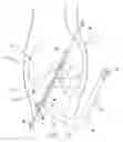 Fig. 15 - Method and apparatus for fixing a graft in a bone tunnel