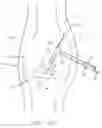 Fig. 19 - Method and apparatus for fixing a graft in a bone tunnel