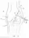 Fig. 20 - Method and apparatus for fixing a graft in a bone tunnel