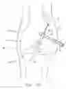 Fig. 22 - Method and apparatus for fixing a graft in a bone tunnel