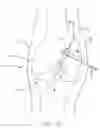 Fig. 23 - Method and apparatus for fixing a graft in a bone tunnel