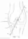 Fig. 27 - Method and apparatus for fixing a graft in a bone tunnel