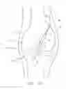 Fig. 28 - Method and apparatus for fixing a graft in a bone tunnel