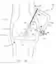 Fig. 29 - Method and apparatus for fixing a graft in a bone tunnel