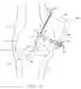 Fig. 30 - Method and apparatus for fixing a graft in a bone tunnel