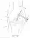 Fig. 31 - Method and apparatus for fixing a graft in a bone tunnel