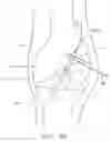Fig. 32 - Method and apparatus for fixing a graft in a bone tunnel
