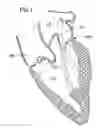Fig. 02 - Annuloplasty ring for mitral valve prolapse