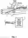 Fig. 02 - Venous needle dislodgement sensor