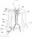 Fig. 01 - Expandable trans-septal sheath