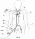 Fig. 04 - Expandable trans-septal sheath