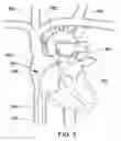 Fig. 06 - Expandable trans-septal sheath