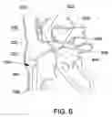 Fig. 07 - Expandable trans-septal sheath