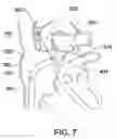Fig. 08 - Expandable trans-septal sheath