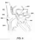 Fig. 09 - Expandable trans-septal sheath