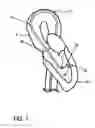 Fig. 02 - Intra-ventricular substance delivery catheter system