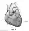 Fig. 02 - Small vessel stent designs