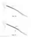 Fig. 06 - Small vessel stent designs