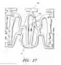 Fig. 18 - Slide-and-lock stent