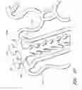 Fig. 28 - Slide-and-lock stent